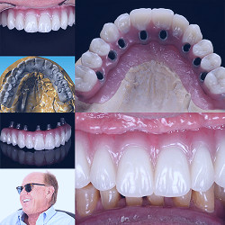 Full Implant Teeth Replacement | Sarasota Oral and Implant Surgery